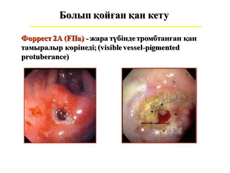 Болып қойған қан кету Форрест 2А (FIIa) - жара түбінде тромбтанған қан тамыралыр көрінеді;